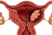 5 semne timpurii ale cancerului de col uterin – o boala care ia viata a milioane de femei