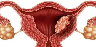 5 semne timpurii ale cancerului de col uterin – o boala care ia viata a milioane de femei