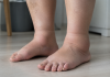 Semnul care apare pe picioare și pe care mulți îl ignoră. Medicii spun că poate avea legătură cu circulația Picioare umflate și glezne mărite care pot indica probleme de circulație