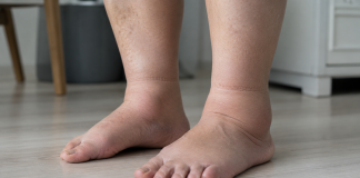 Semnul care apare pe picioare și pe care mulți îl ignoră. Medicii spun că poate avea legătură cu circulația Picioare umflate și glezne mărite care pot indica probleme de circulație